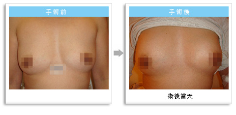 彭玉文医师隆乳丰胸案例