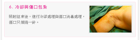 彭玉文医师3合1极细光纤腋下除味术