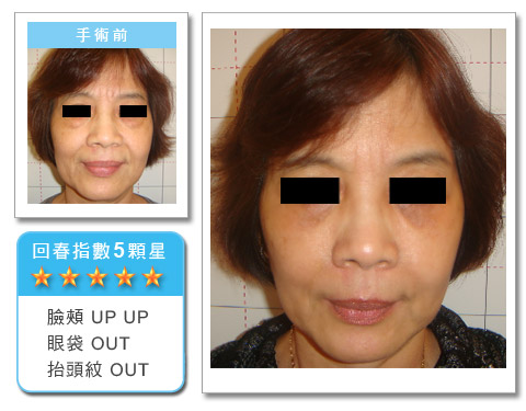彭玉文医师羽毛拉皮