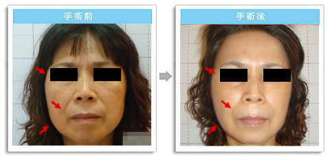 彭玉文醫師韓式隆3D拉皮範例